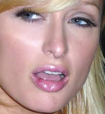 herpes simplex