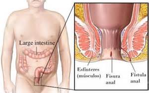 Anal Fissures Altsberglotion Product