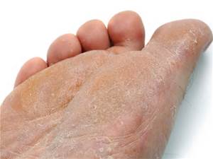 Athletes Foot Altsberglotion Product