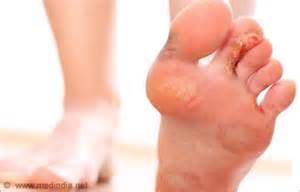 Athletes Foot Altsberglotion Product