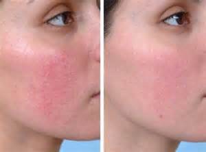 Rosacea Altsberglotion Product