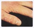 hand warts