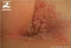 genital warts cure