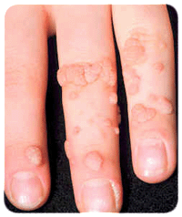 common warts