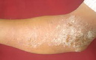 Eczema