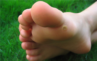 Plantar Warts