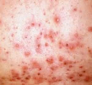Acne and boils Altsberglotion Product Acne and boils Altsberglotion Product