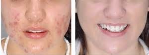 Acne Altsberglotion Product Acne Altsberglotion Product