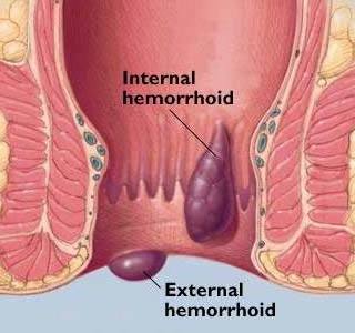 Altsberglotion - Hemorrhoids Cure